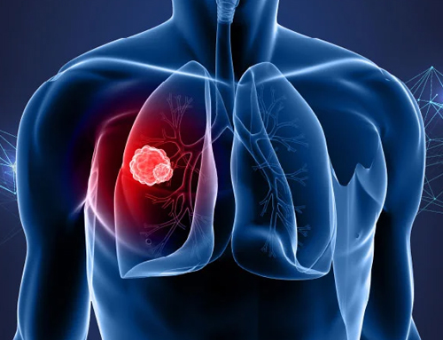 Lung Cancer